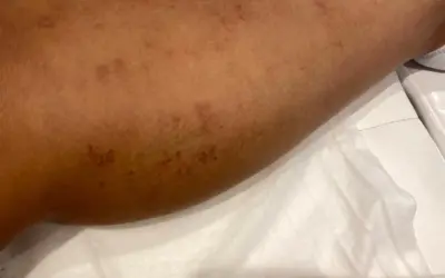 Verbrannte Haut nach Laserbehandlung: Ursachen, Risiken und Hilfe