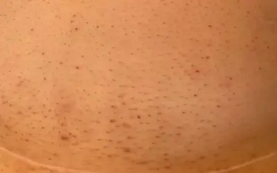 Eingewachsene Haare im Intimbereich
