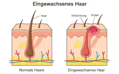 Eingewachsene Haare und wie du Sie loswirst