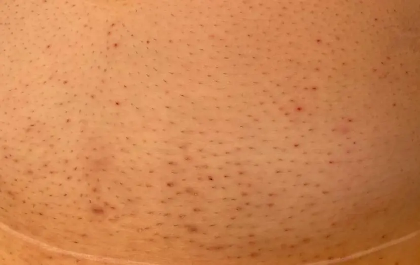 eingewachsene-haare-intimbereich-behandlung